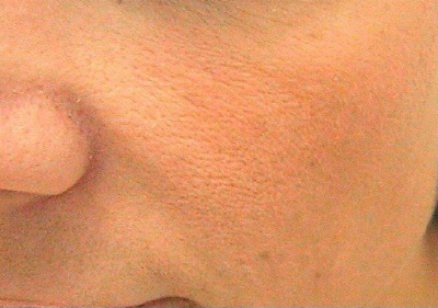 Gesichtshaut nach Spezialtherapie DrZenker DepiFasrPeel DFP©